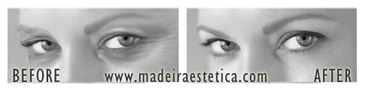 Eyelid Reshaping - Madeira Estetica