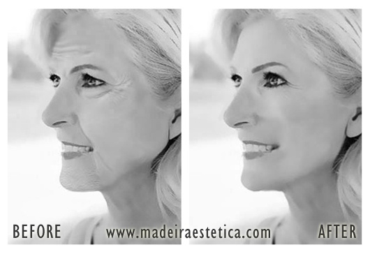 Lifting Facial - Madeira Estetica