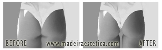 Liposuction - Madeira Estetica