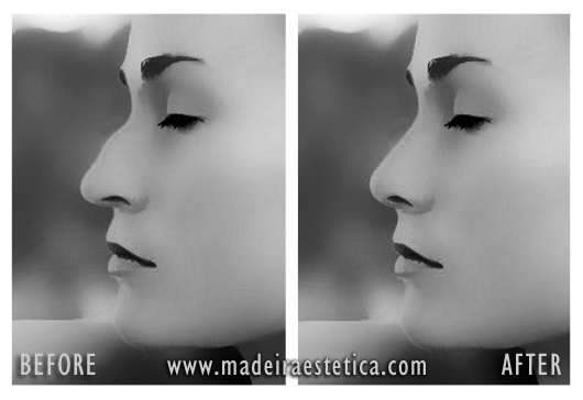 Nose Reshaping