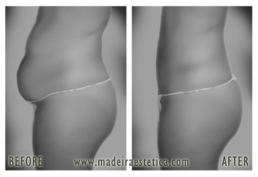 Tummy Tuck - Madeira Estetica